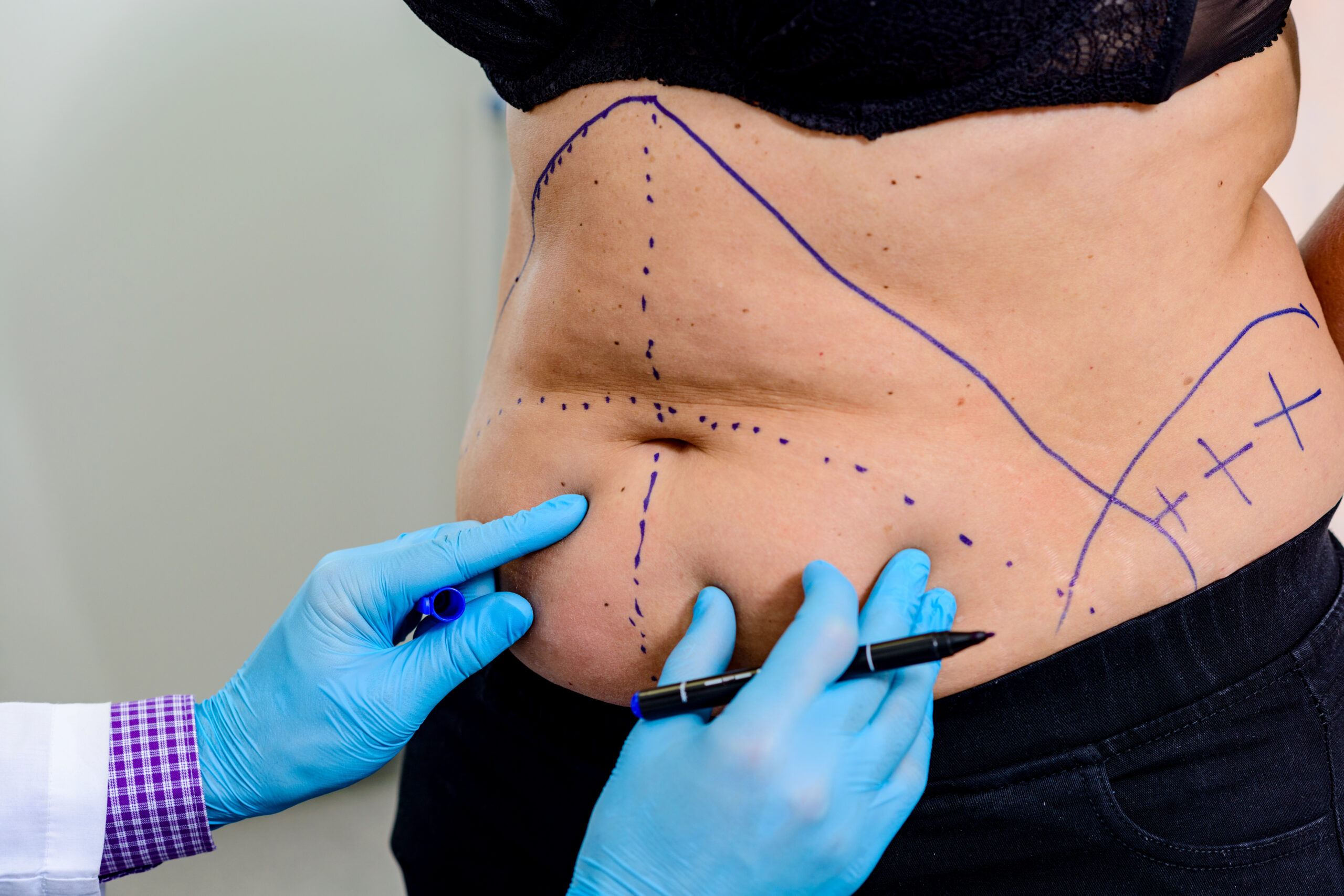 Ultrason Destekli Liposuction